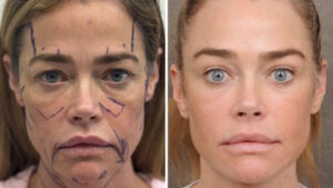 Denise Richards’ Raw Facelift Before-and-After Photos Are the Transparency We Need